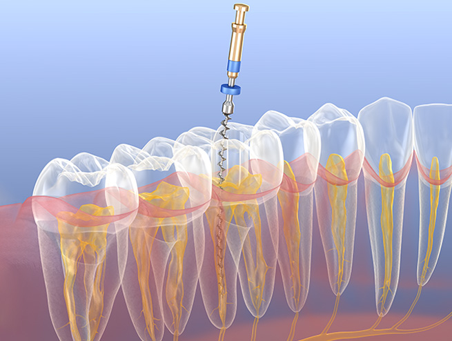 farmadent-tratamiento-endodoncia