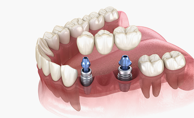 farmadent-tratamiento-implantologia